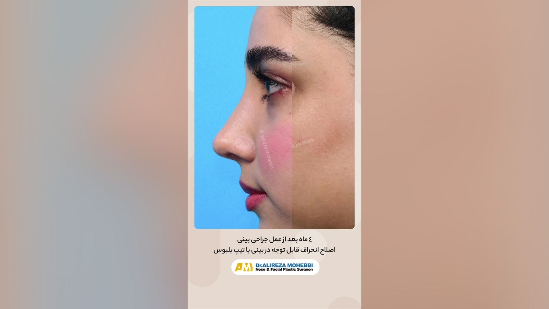4ماه بعد از جراحی بینی اصلاح انحراف بینی در تهران