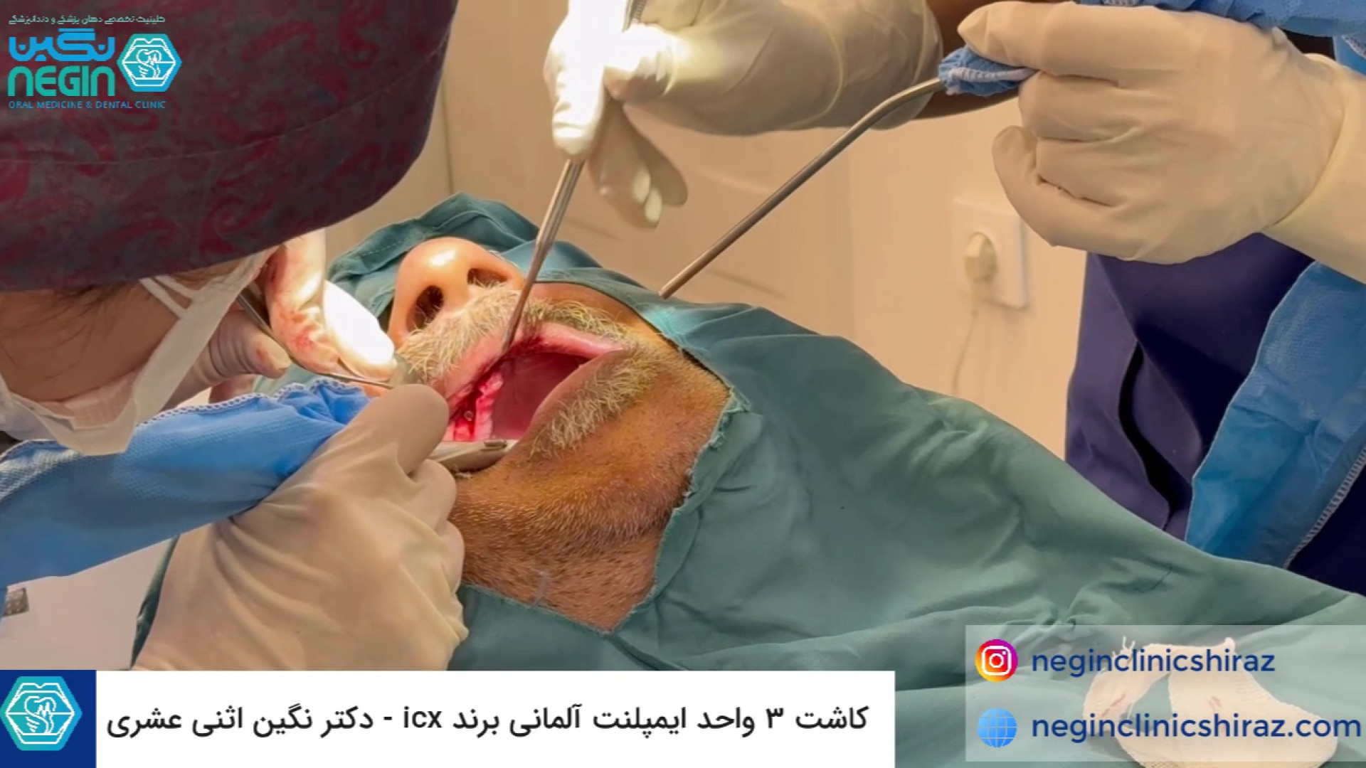 ویدیو کاشت 3 واحد ایمپلنت آلمانی برند ICX - دکتر نگین اثنی عشری Screening Lentiviral Vector
