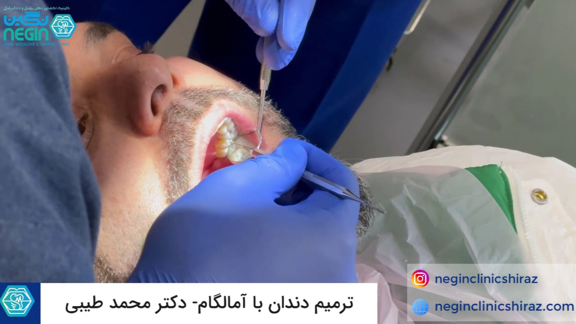 ترمیم و پر کردن دندان در شیراز - دکتر محمد طیبی ایمونوانژیوگرافی