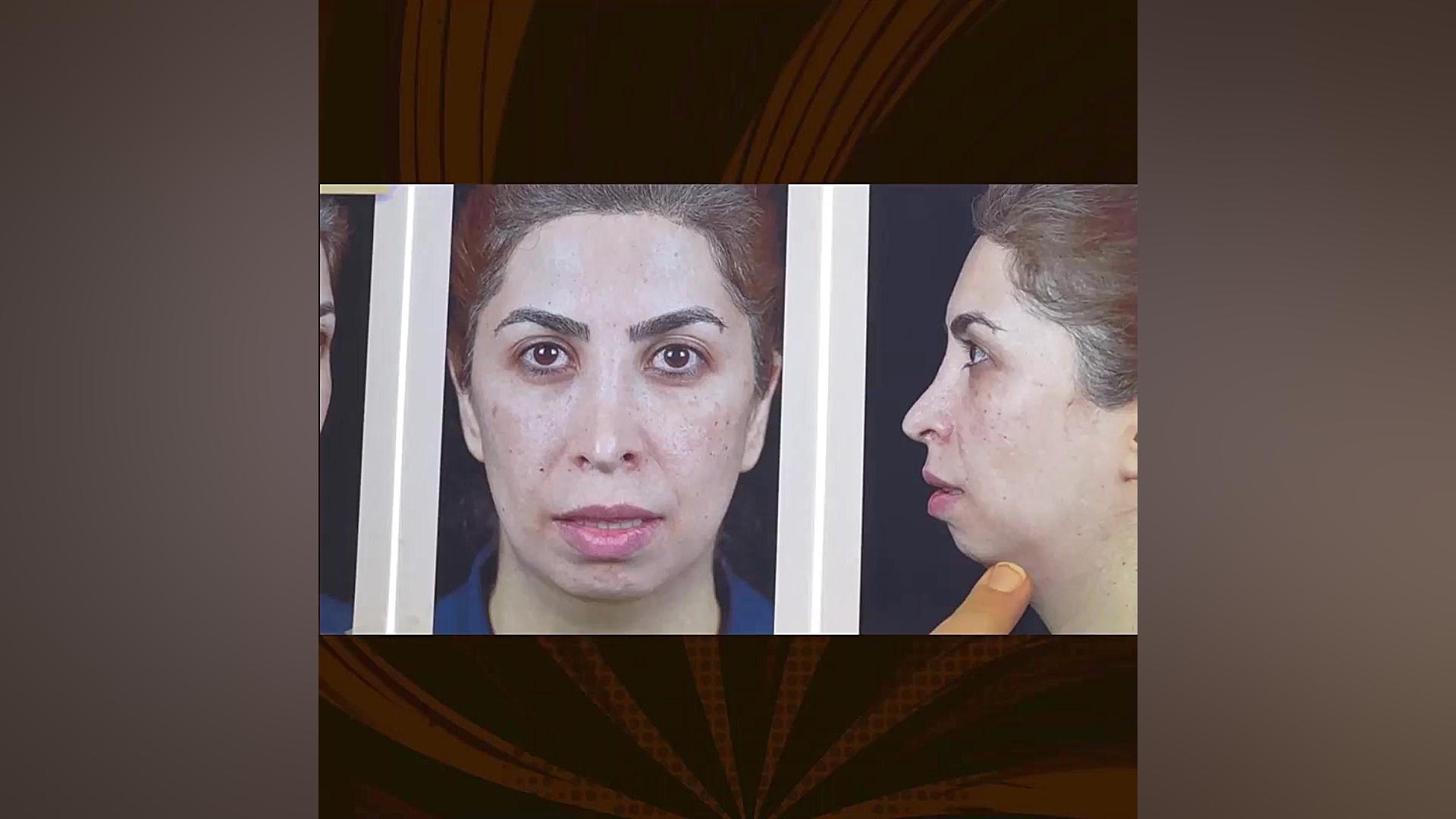 قبل و بعد جراحی فک و صورت کربوکسی تراپی
