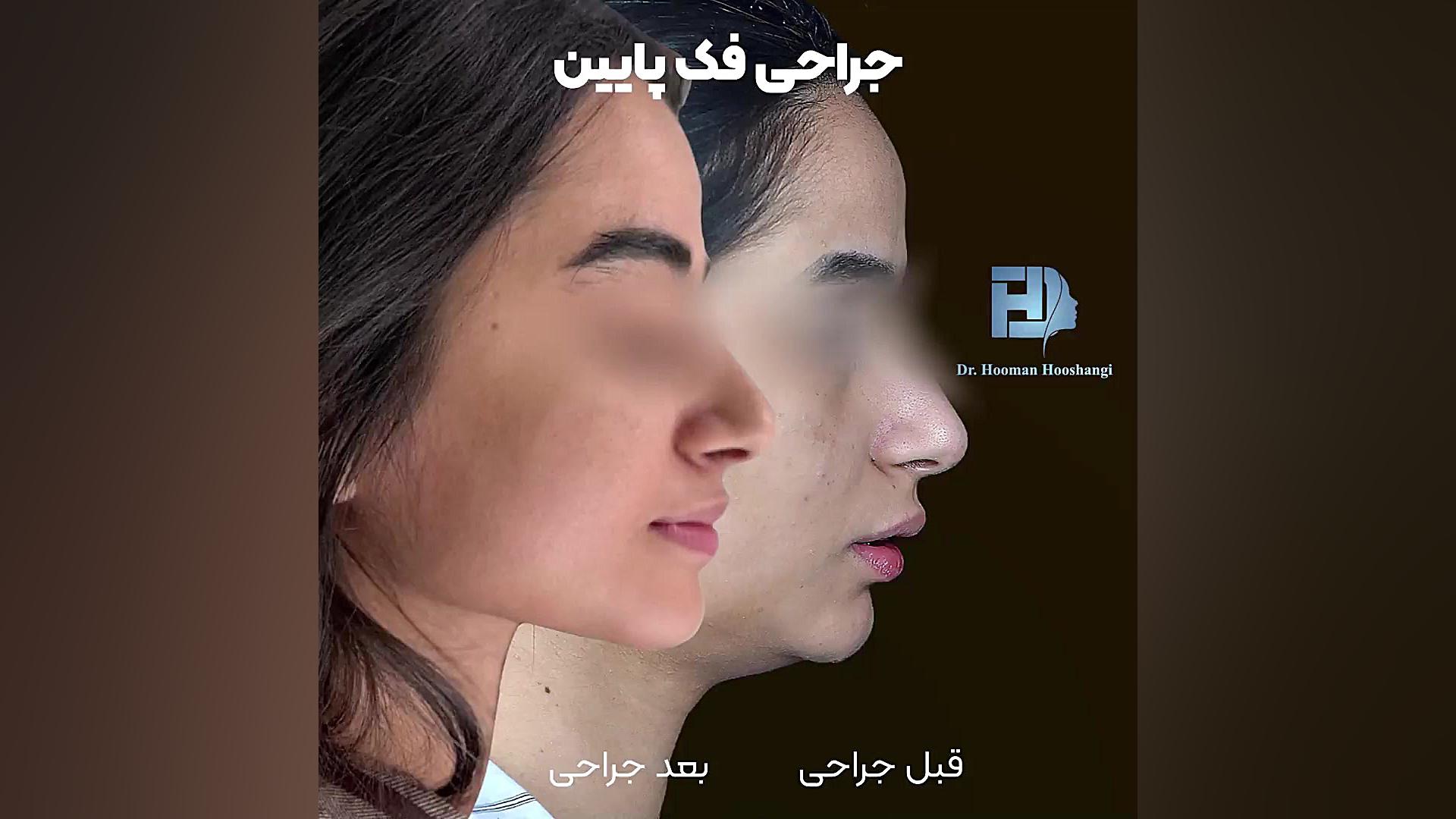 قبل و بعد جراحی فک و صورت In Situ Hybridization