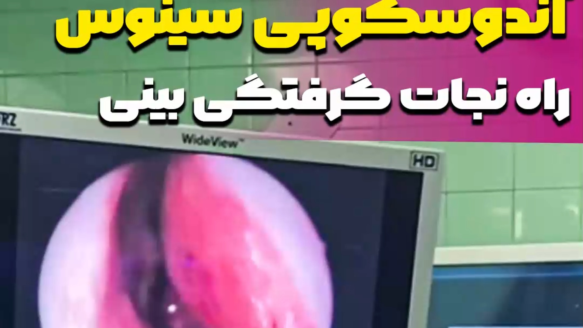 آندوسکوپی سینوس درمان سینوزیت مزمن توسط دکتر متین قاضی زاده حامد همایون