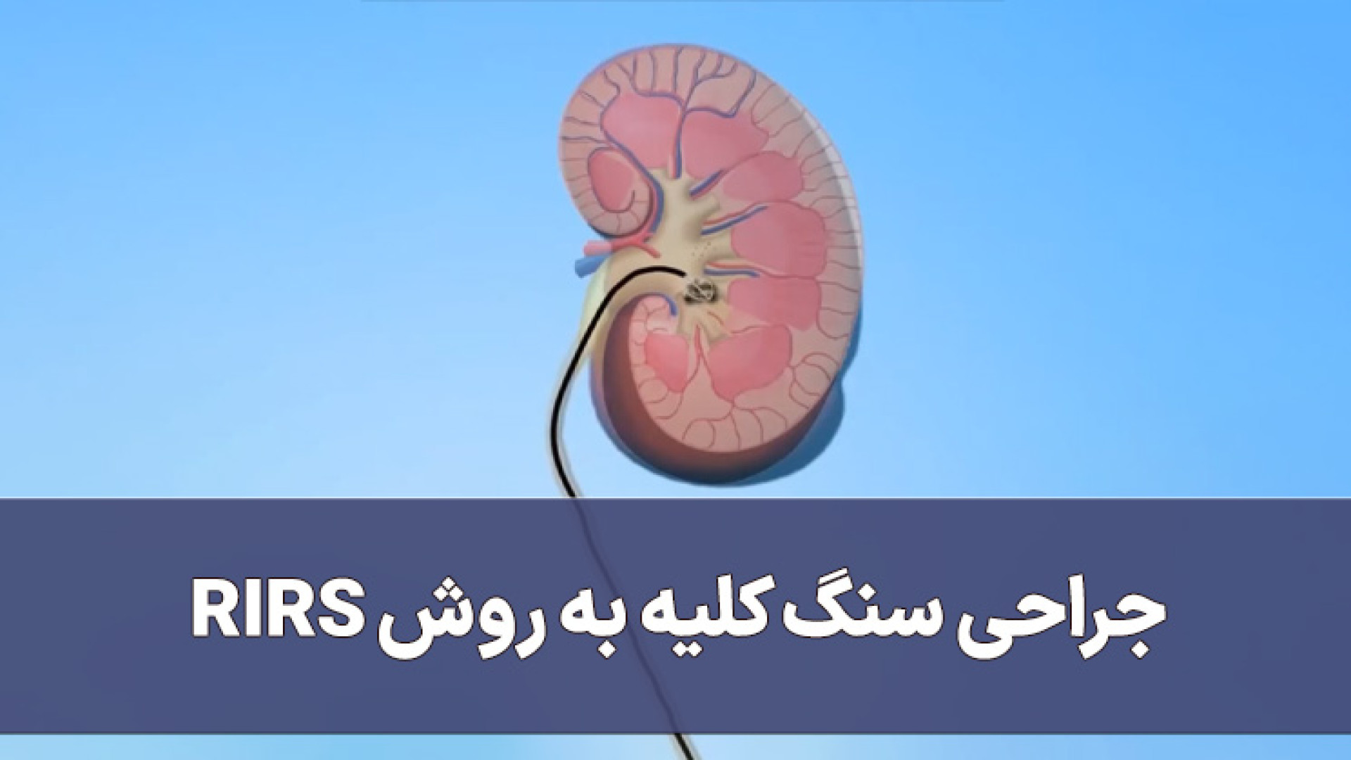 جراحی سنگ کلیه به روش RIRS برداشتن خال گوشتی