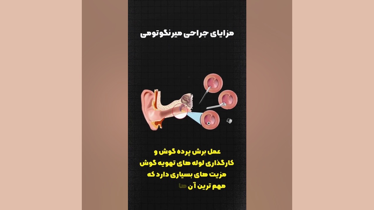 میرنگوتومی | دکتر بهروز امیرزرگر لیپوساکشن