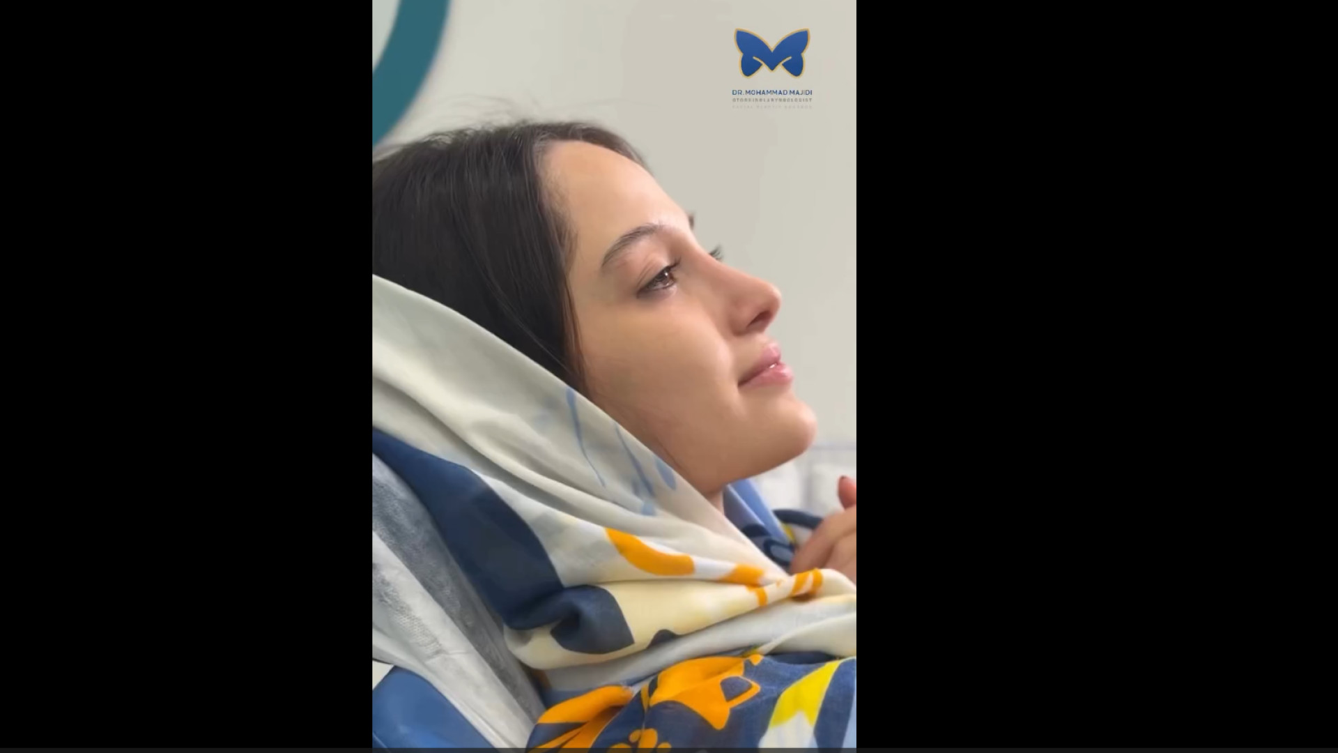 نتیجه عمل بینی غضروفی - استخوانی با انحراف شدید | دکتر مجیدی دکتر محمد مجیدی - جراحی بینی به سبک طبیعی شیک