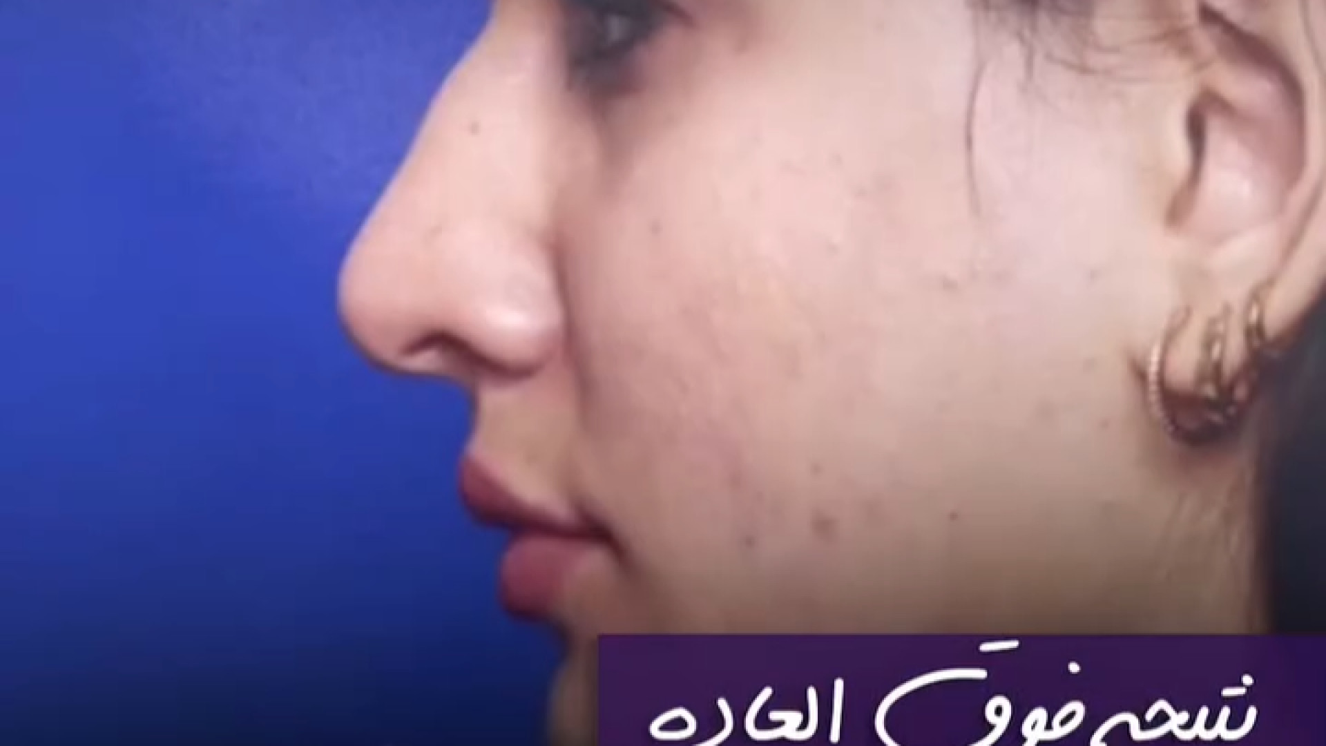 تیجه جراحی بینی گوشتی و اصلاح تمامی نواقص | دکتر علی حسینی واجاری دکتر علی حسینی واجاری - جراح بینی رشت