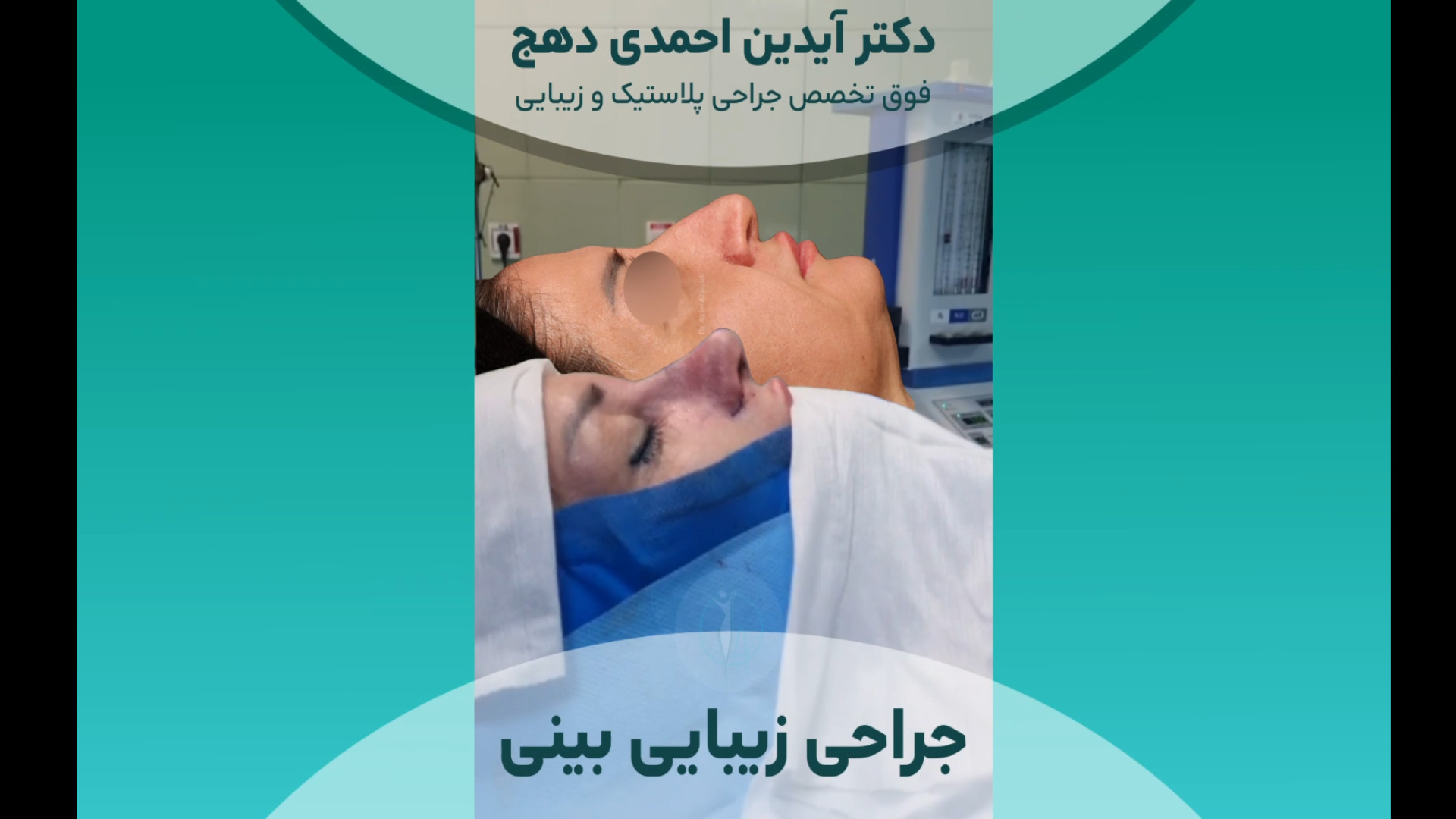 نتیجه فوق العاده جراحی بینی گوشتی دکتر آیدین احمدی دهج | جراح پلاستیک