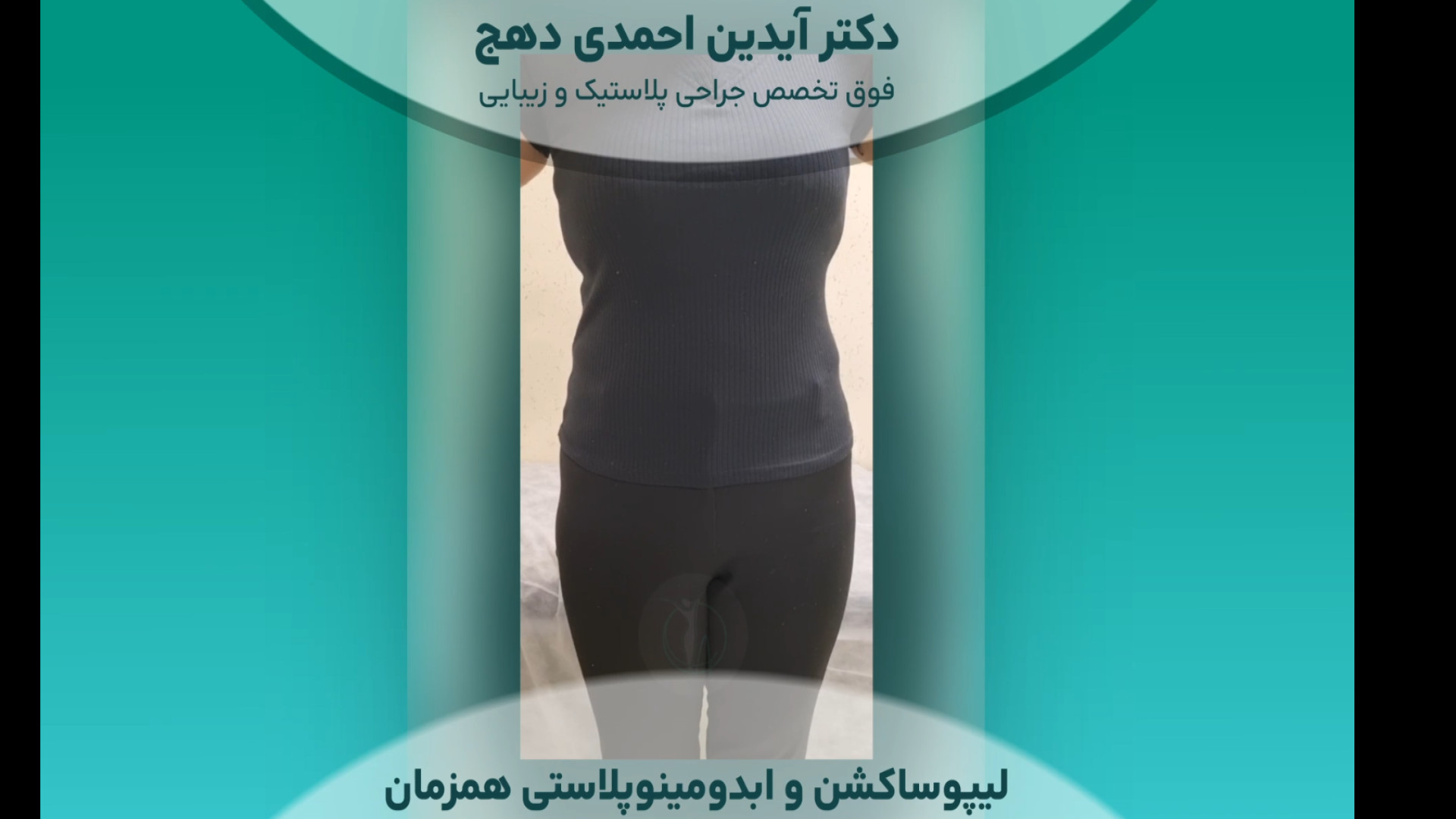 نتیجه جراحی لیپوساکشن و ابدومینوپلاستی دکتر آیدین احمدی دهج | جراح پلاستیک