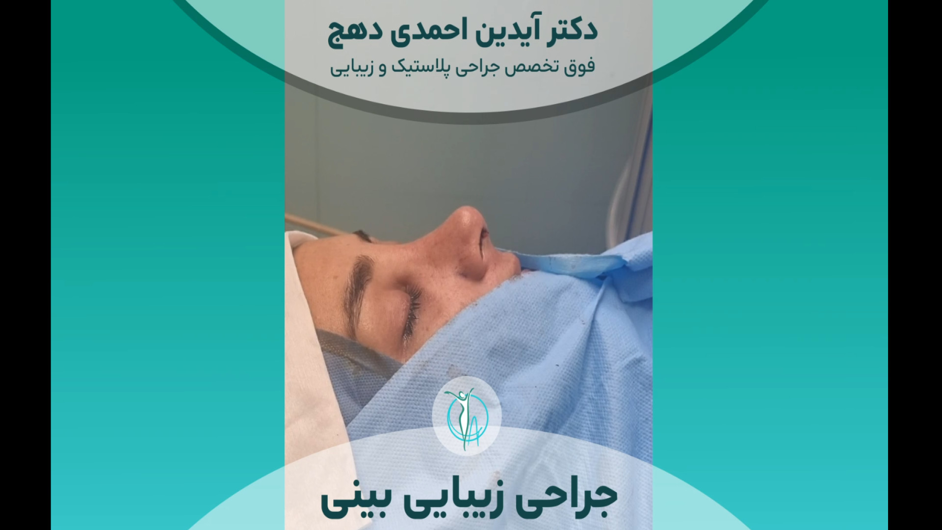 نتیجه بینظیر جراحی بینی گوشتی و کج دکتر آیدین احمدی دهج | جراح پلاستیک