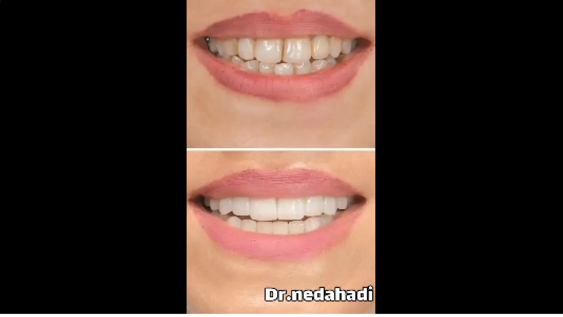 اصلاح طرح لبخند دکتر ندا هادی-دندانپزشک زیبایی