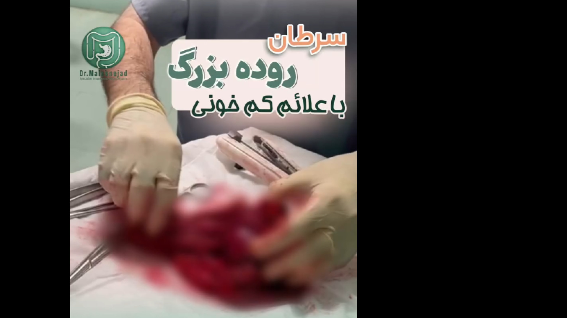 سرطان روده بزرگ لیزر مو