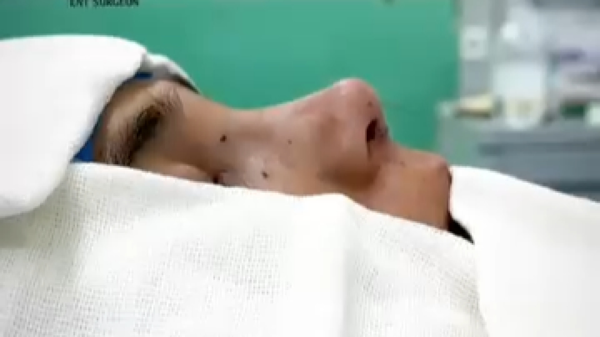 نتیجه بلافاصله بعد از جراحی بینی | دکتر مهدی بنائی