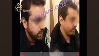 کاشت ریش و سبیل - کاشت مو و ترمیم مو رنسانس بیماری کلوتزوکس
