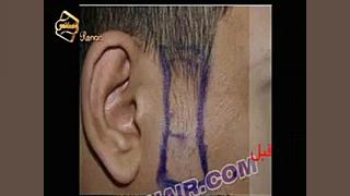 کاشت ریش و سبیل - کاشت مو و ترمیم مو رنسانس رادیوگرافی دندان