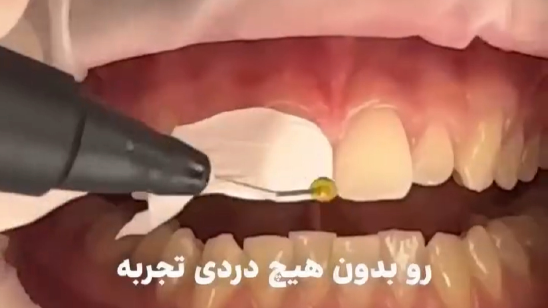 کامپوزیت ونیر دندان درد داره؟ بیماری پلی‌سیتمی ورا