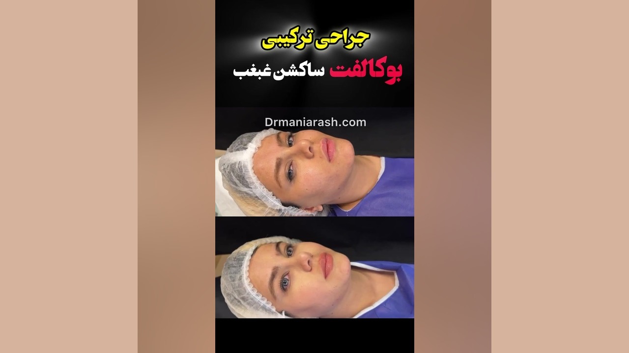 حذف چربی بوکال دکتر مانی آرش راد جراح فك و صورت