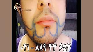 82-کاشت ریش و سبیل به روش SUT مرکز مو رنسانس (2).mp4 پزشکی نانوذره‌ای
