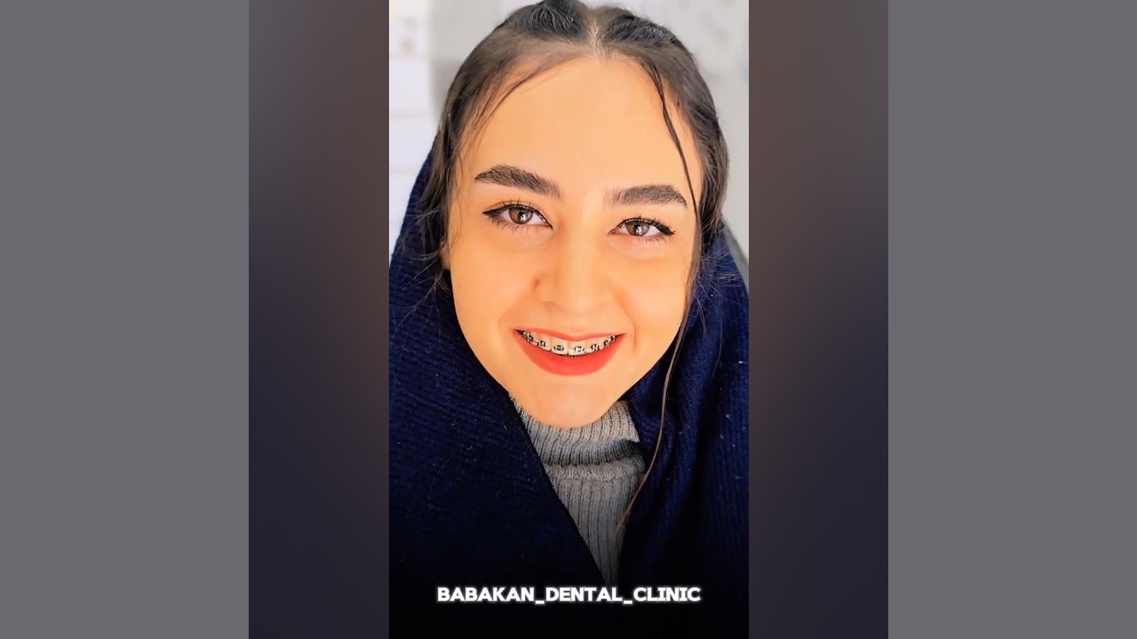 پایان درمان ارتودنسی کلینیک دندانپزشکی بابکان