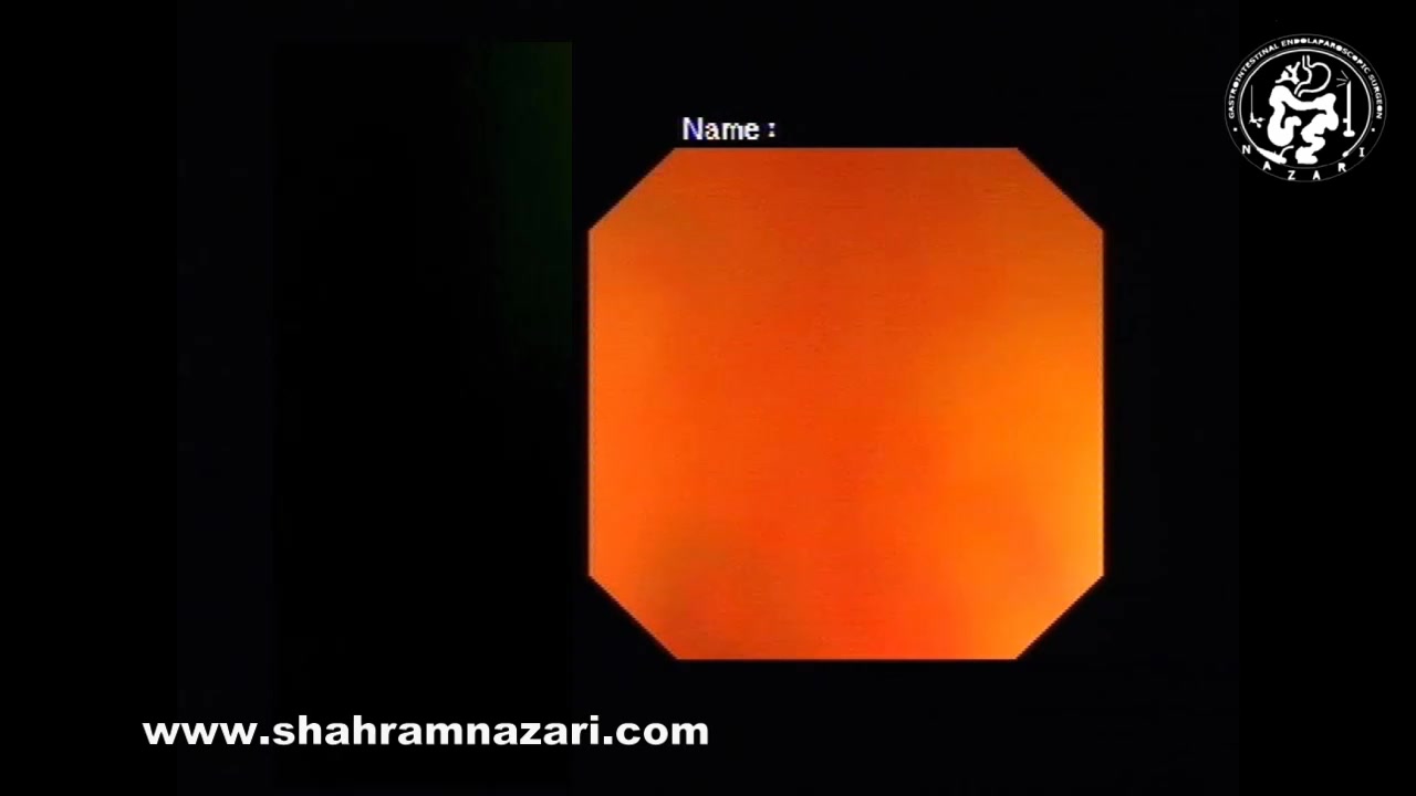 بستن با کلیپس در جلوگیری خونریزی پس از برداشتن آندوسکوپی پولیپ‌های بزرگ روده ابرسانی پوست