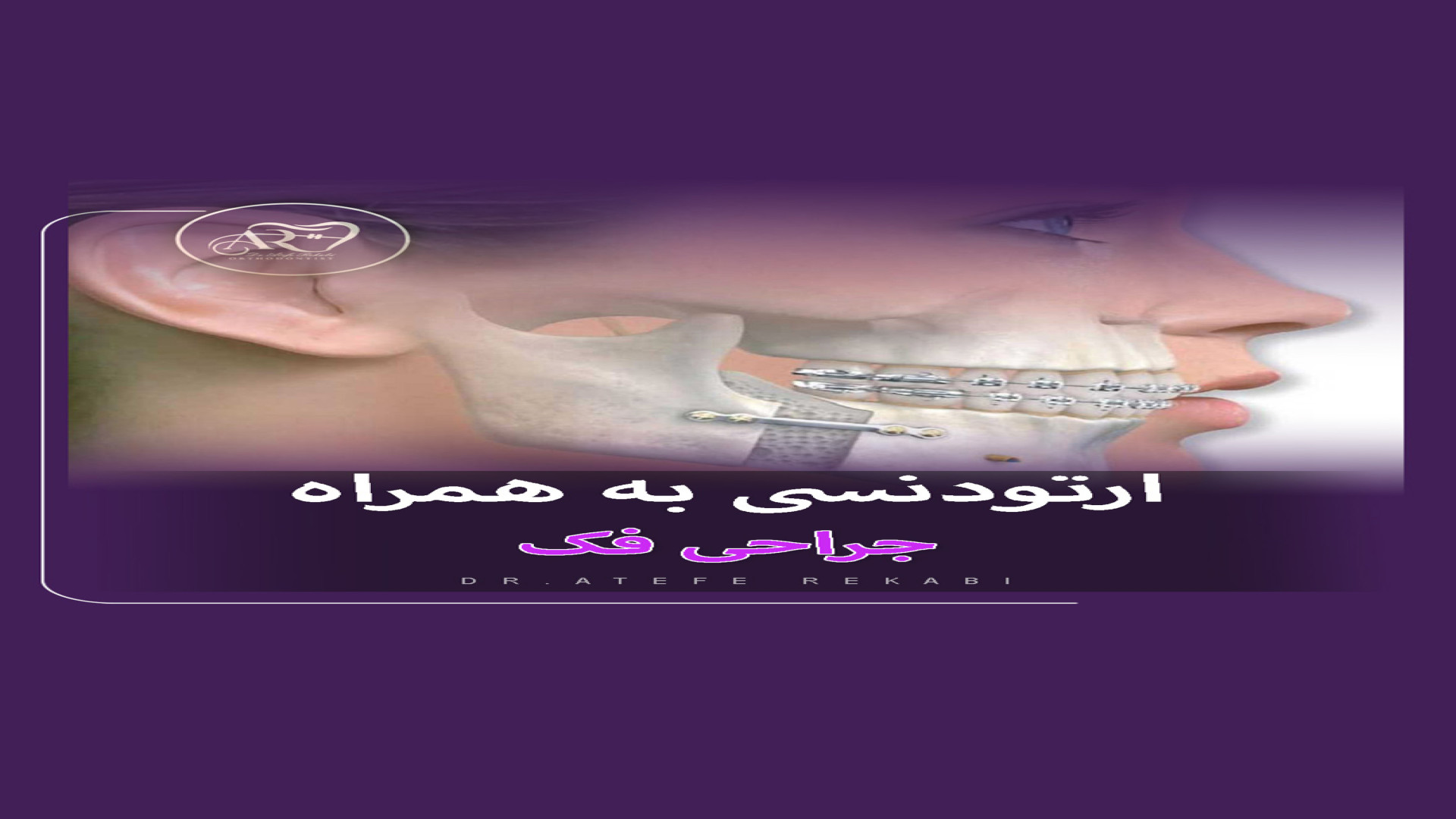ارتودنسی به همراه جراحی فک دکتر عاطفه رکابی