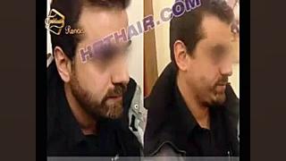 کاشت ریش و سبیل به روش SUT مرکز مو رنسانس Screening Lentiviral Vector