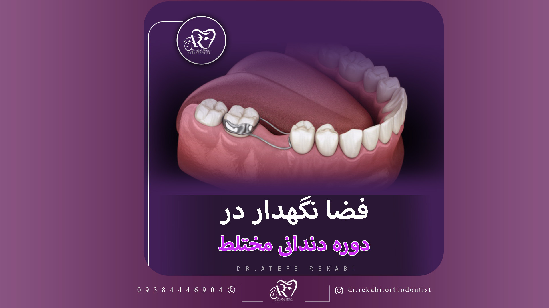 فضا نگهدارند در دوره دندانی مختلط دکتر عاطفه رکابی