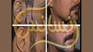 کاشت ریش و سبیل به روش SUT مرکز مو رنسانس ساکوبیتریل