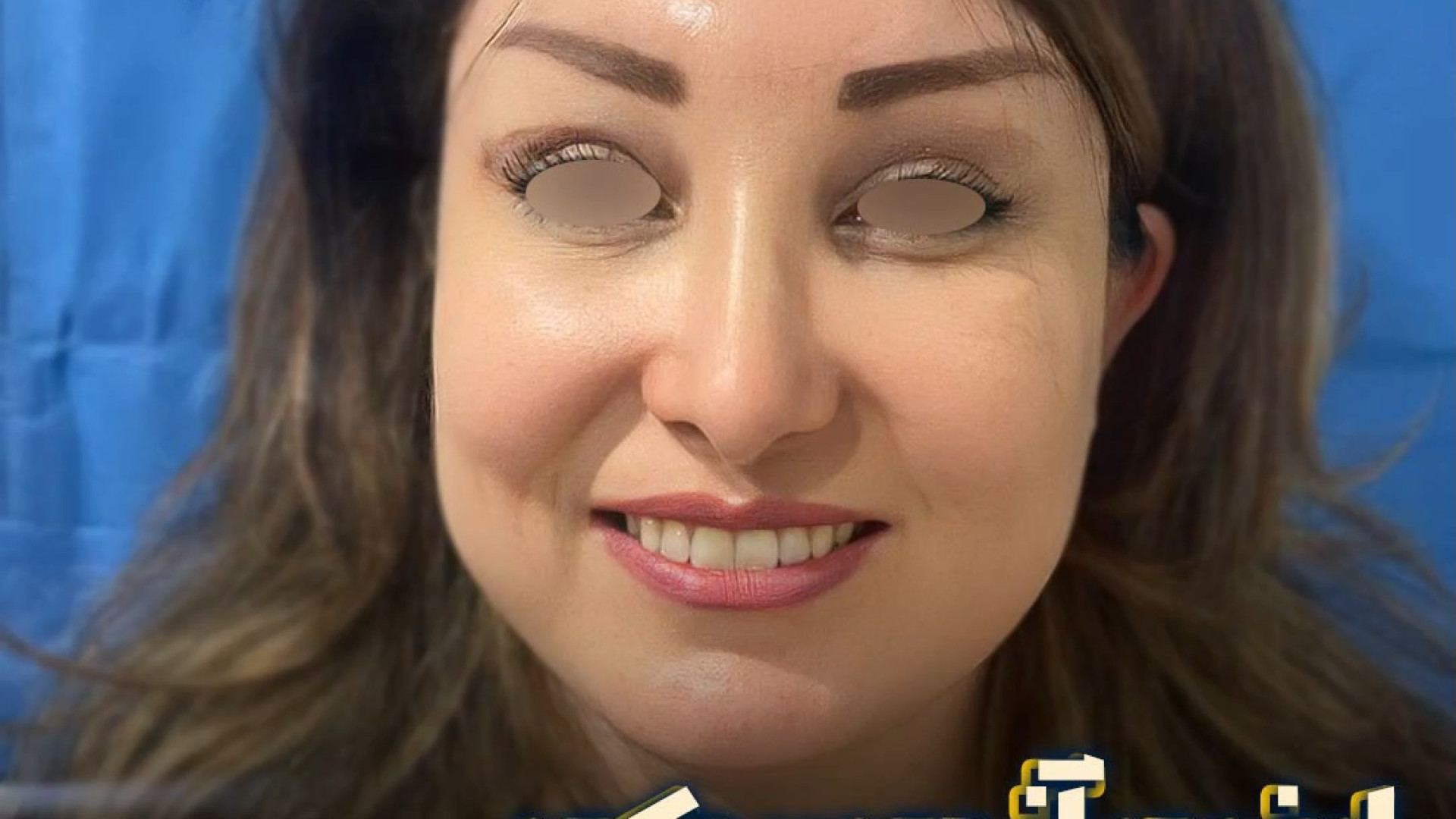 لیفت آندوسکوپی پیشانی و ابرو | دکتر عطاالله حیدری هیدروپس فتالیس