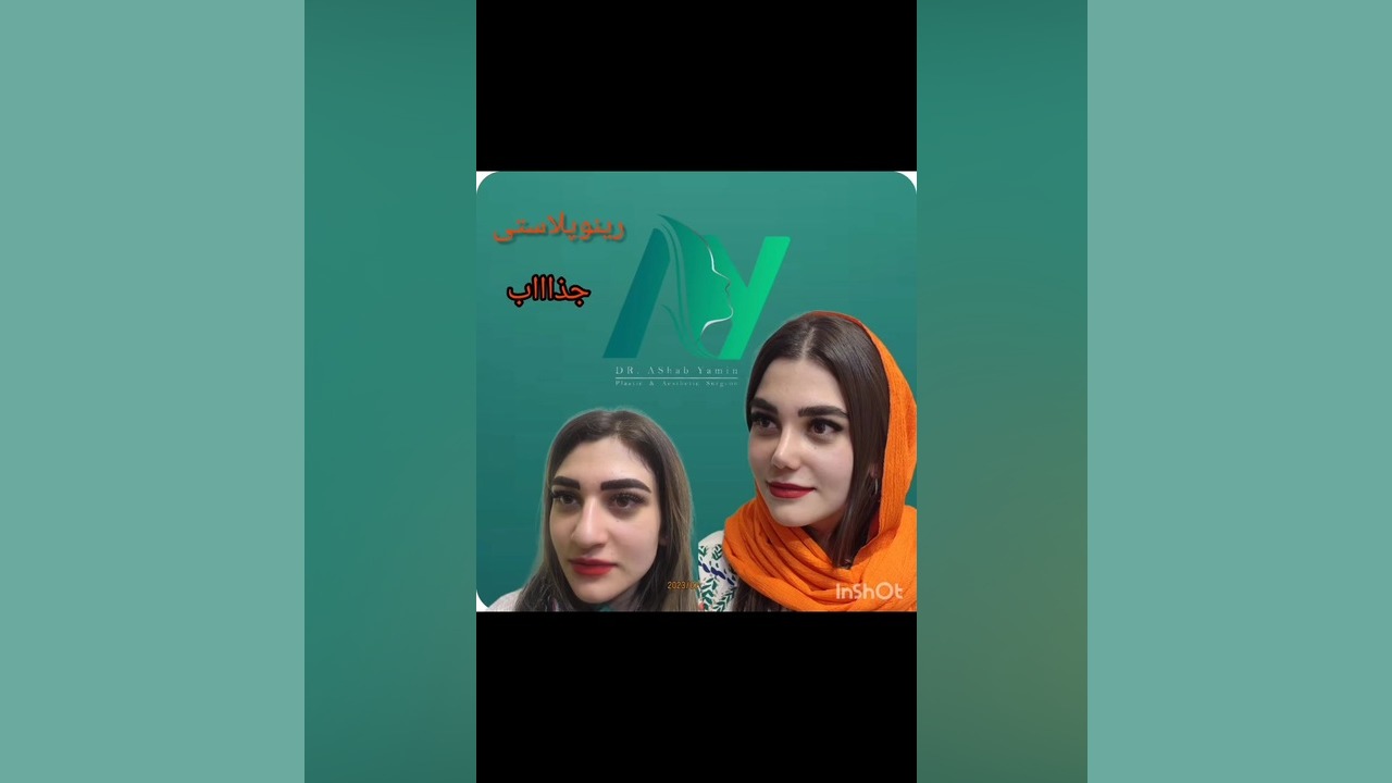 قبل و بعد از عمل بینی گوشتی دکتر محمودرضا اصحاب یمین - فوق تخصص پلاستیک