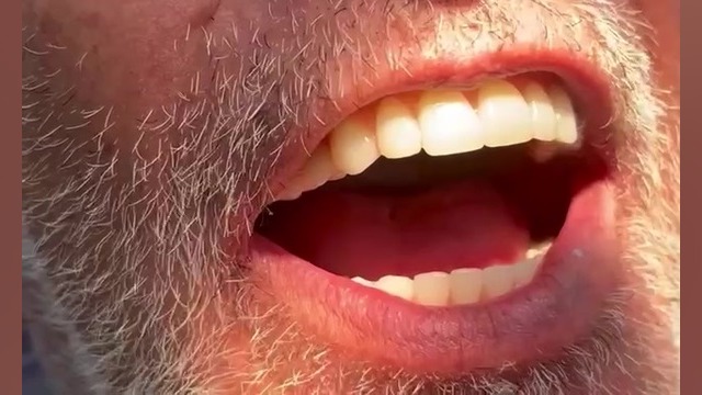 تجربه کاشت ایمپلنت کامل – بازیابی لبخند با دندانپزشکی آرال لیپوست