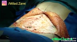 جراحی لاغری شکم پهلو tummy tuc...