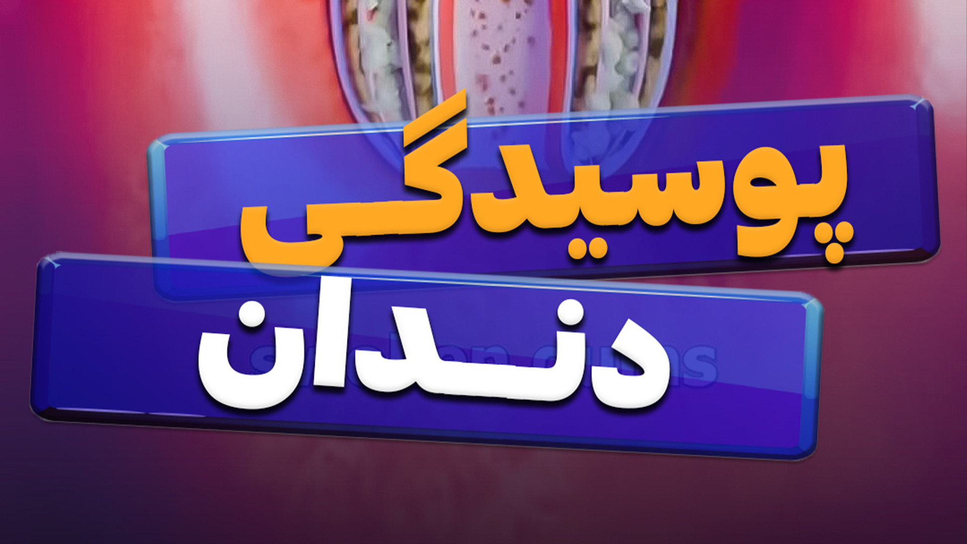 پوسیدگی دندان درمان مهاری پیوندی