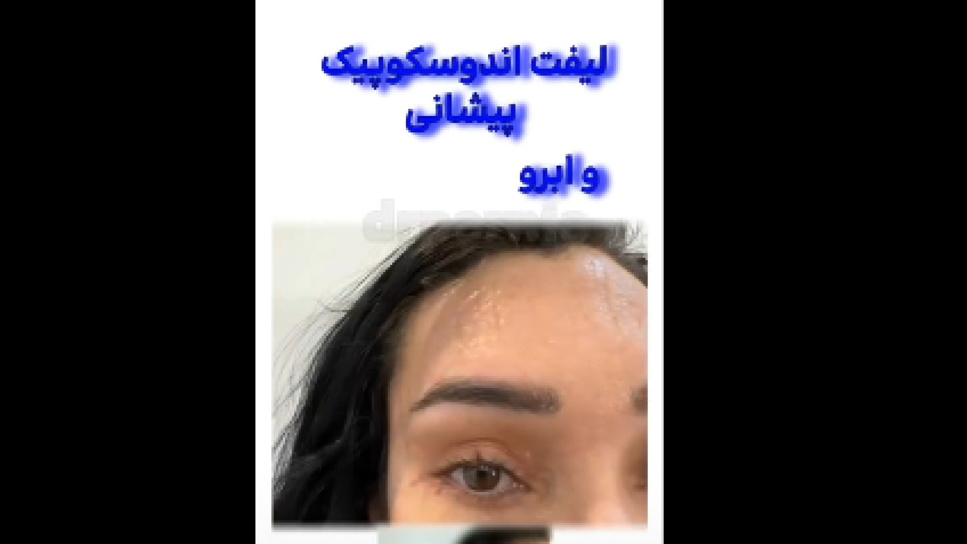 لیفت آندوسکوپي پیشانی دکتر رفیع پرنیا فوق تخصص پلاستیک