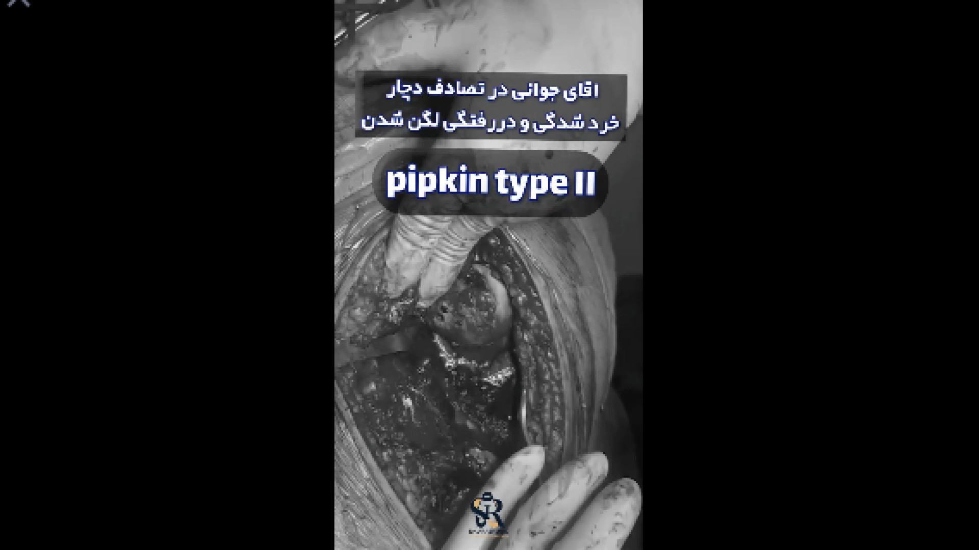 جراحی شکستگی دررفتگی لگن دکتر آرش اریس