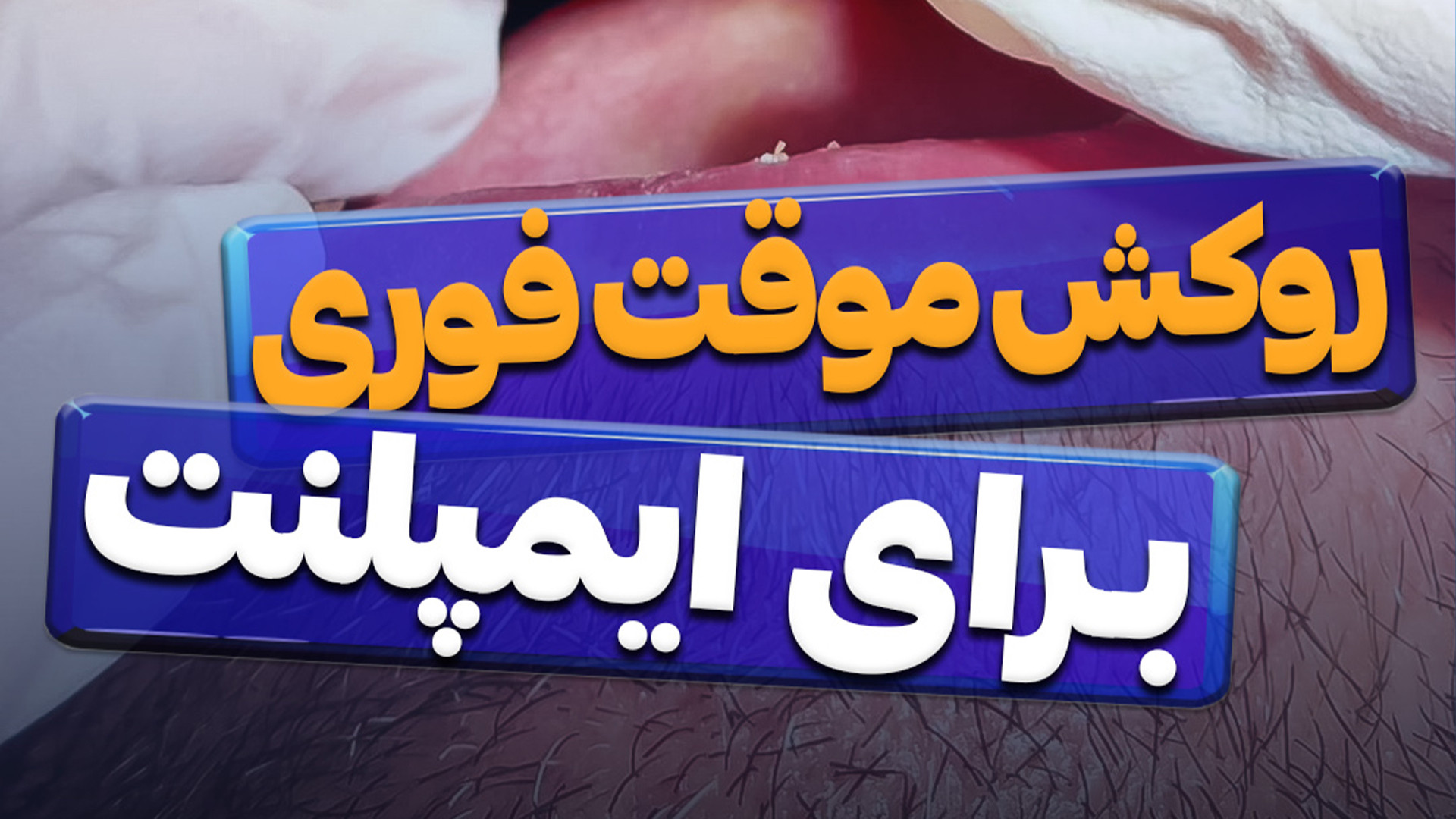 روکش موقت فوری برای ایمپلنت پریودنتیکس
