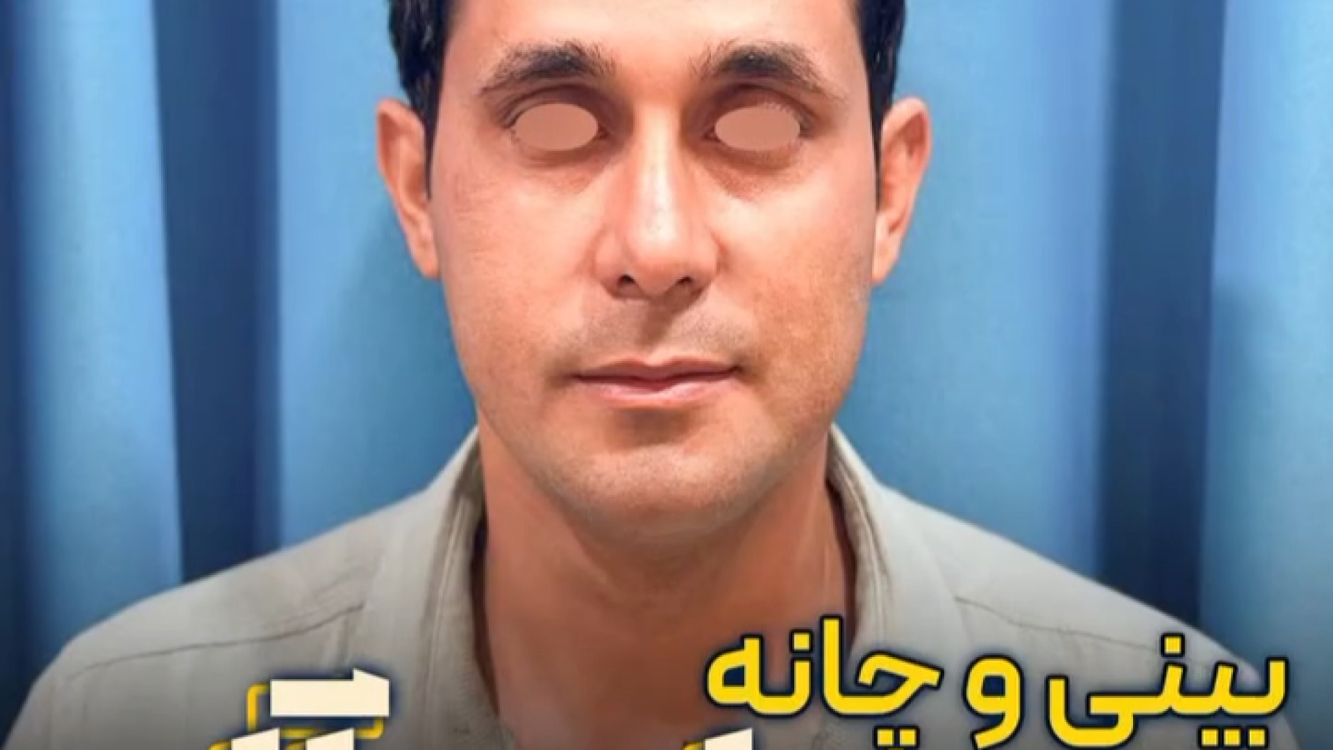 جراحی رینوپلاستی و ژینوپلاستی | دکتر عطاالله حیدری ایم‌دولیموماب