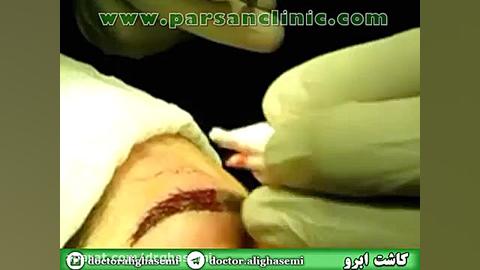 فیلم کاشت ابرو (توسط دکتر علی قاسمی) دکتر علی قاسمی(پوست ، مو ، زیبایی )
