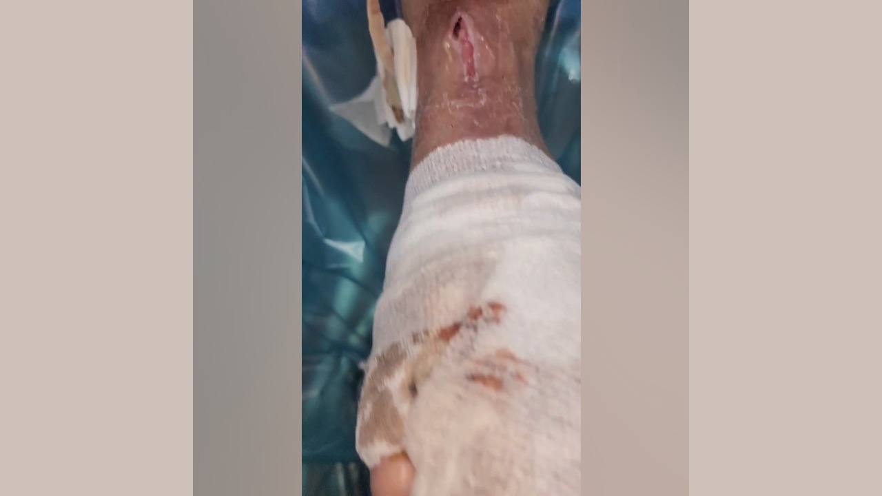 جلسه دوم درمان زخم عفونی با استفاده از پانسمان پلاس مویست زویکو مهدی مهدوی‌کیا