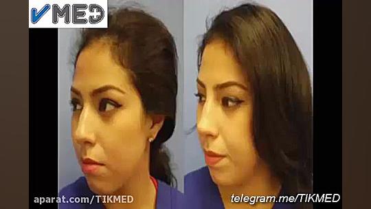 جراحی بینی بدون بیهوشی لیپوست