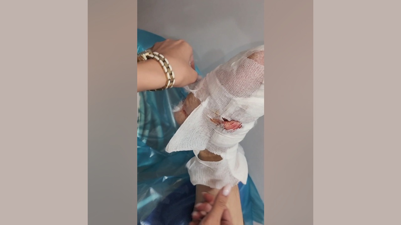 جلسه ششم درمان زخم عفونی با استفاده از پانسمان پلاس مویست زویکو شادمهر عقیلی