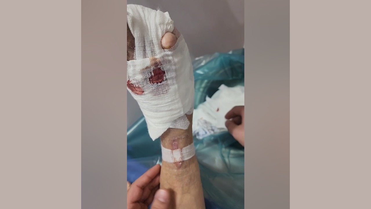 جلسه هفتم درمان زخم عفونی با استفاده از پانسمان پلاس مویست زویکو شکر پنیر