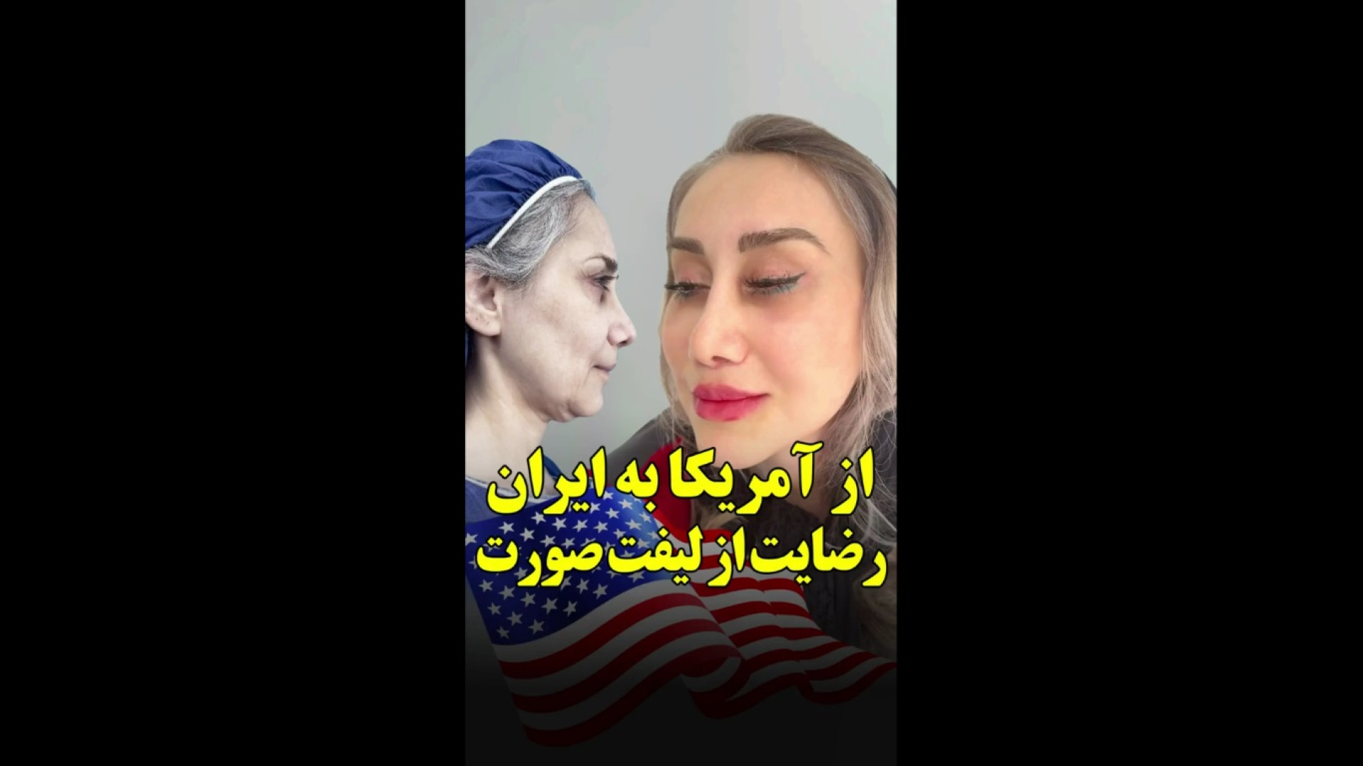 جراحی لیفت صورت و گردن مراجعه کننده از آمریکا ترمیم سوختگی