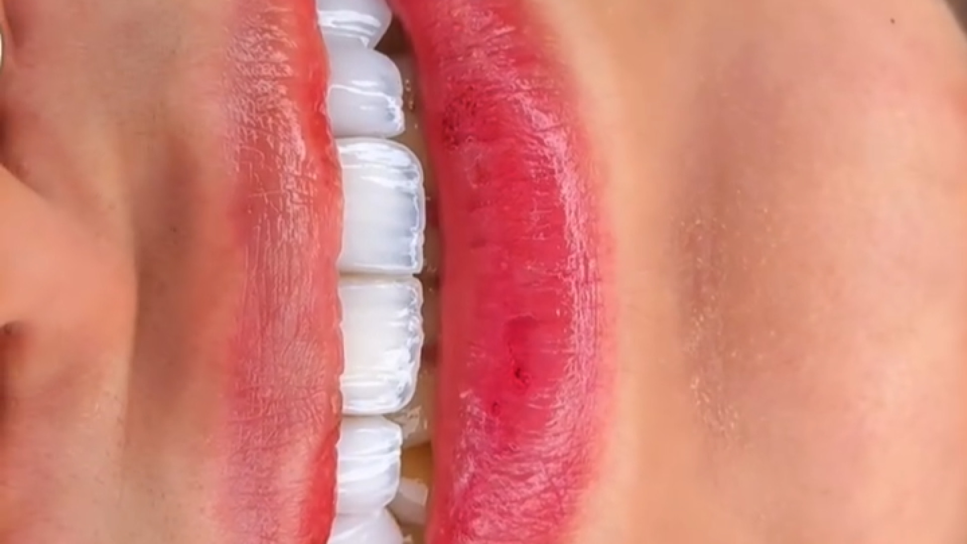 فیلم و عکس لمینت دندان قبل و بعد و ایمپلنت دندان قبل و بعد دکتر پردیس رضوانی پور