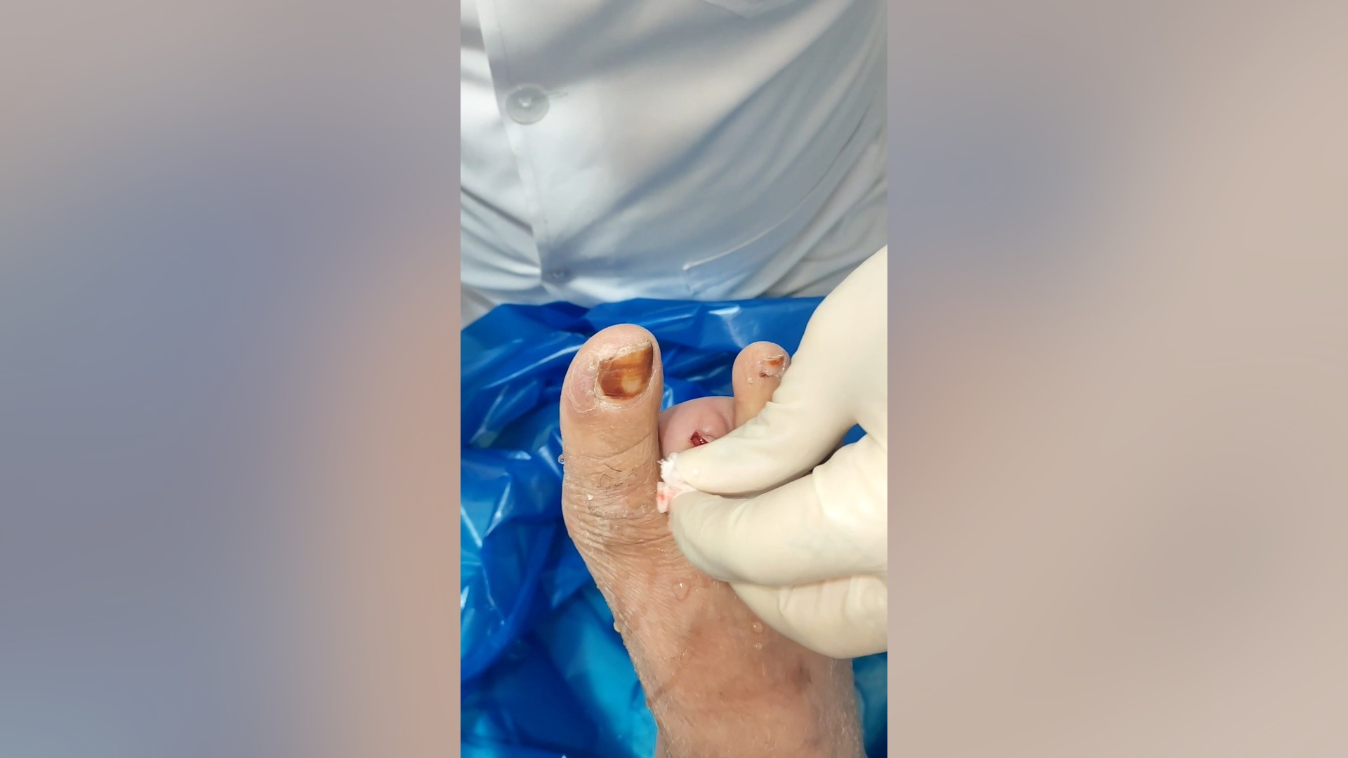 جلسه پنجم درمان زخم عفونی انگشت چهارم پا با استفاده از پانسمان پلاس مویست زویکو تزریق ژل