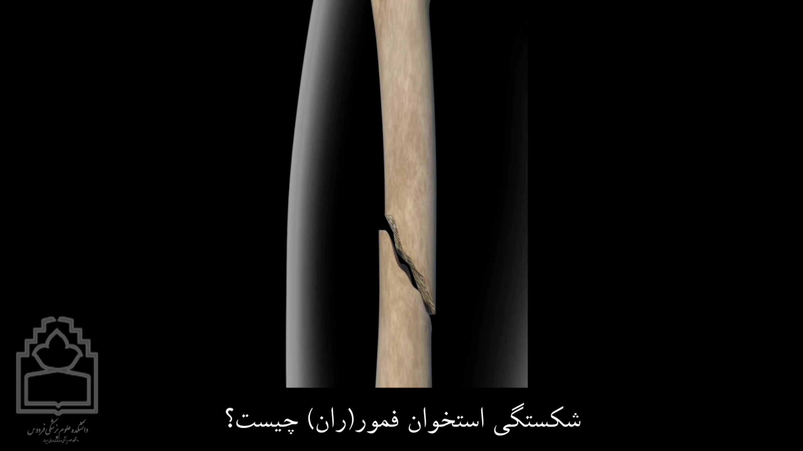 شکستگی فمور (ران پا) لیفت پیشانی