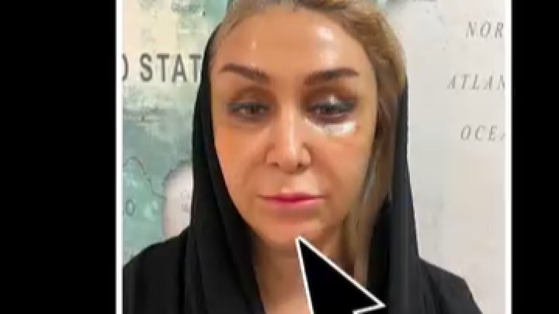 لیفت ابرو شقیقه پلک بالا و پایین دکتر شاهین بهجو - فوق تخصص جراحی پلاستیک