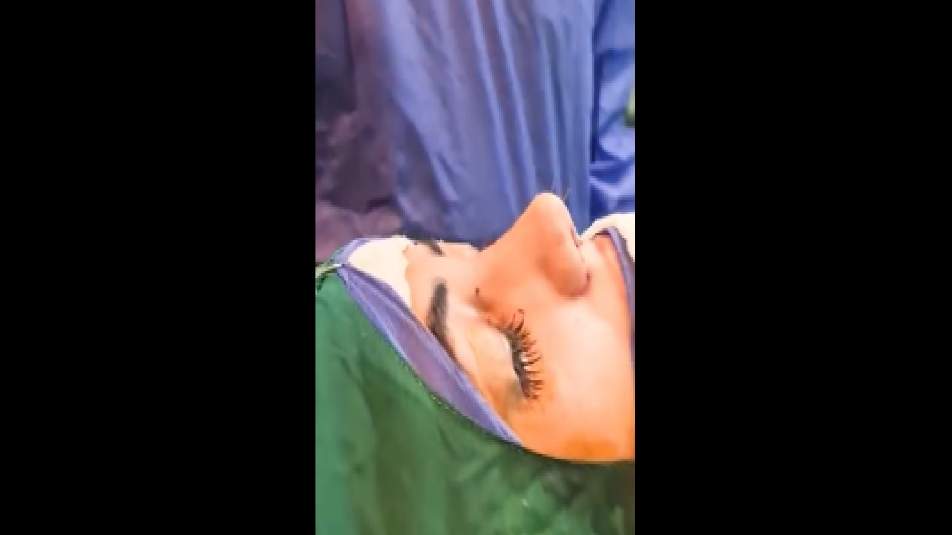 نمونه کار جذاب عمل بینی دکتر شاهین بهجو - فوق تخصص جراحی پلاستیک