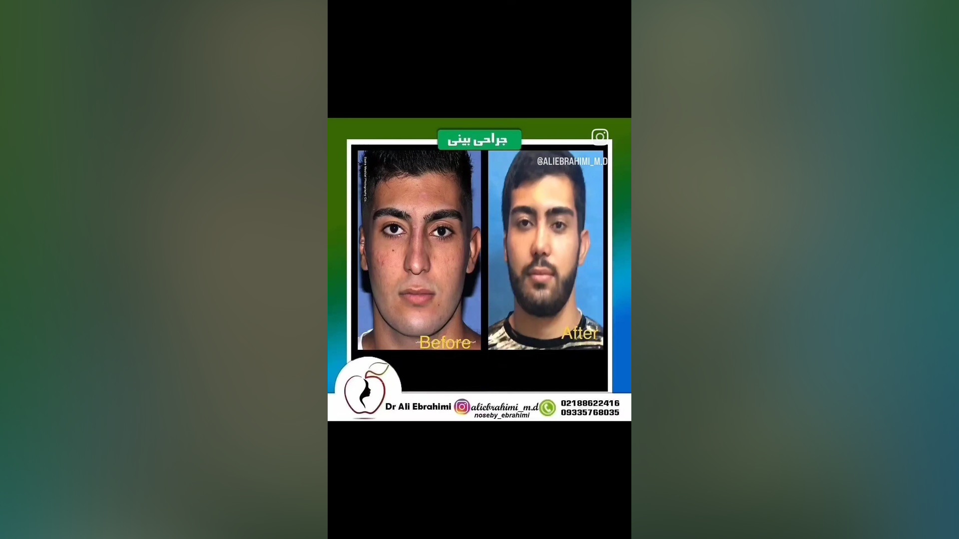 جراحی بینی مردان دکتر علی ابراهیمی فوق تخصص جراحی پلاستیک .