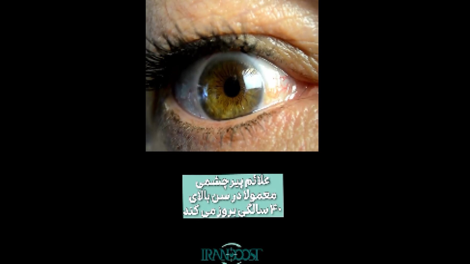 علائم پیر چشمی ویل اسمیت