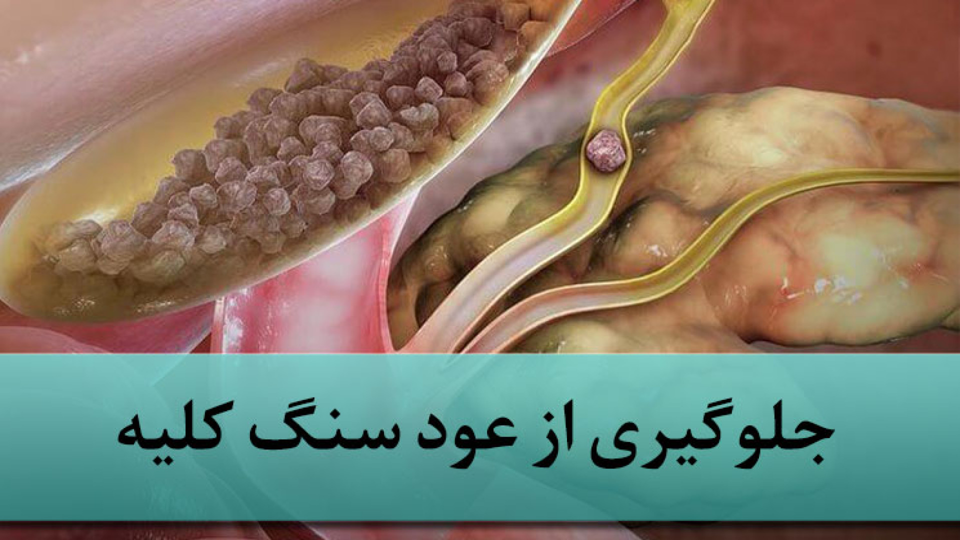 جلوگیری از عود سنگ کلیه کامپوزیت ونیر